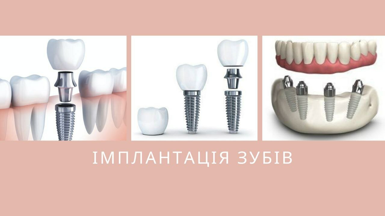 Імплантація