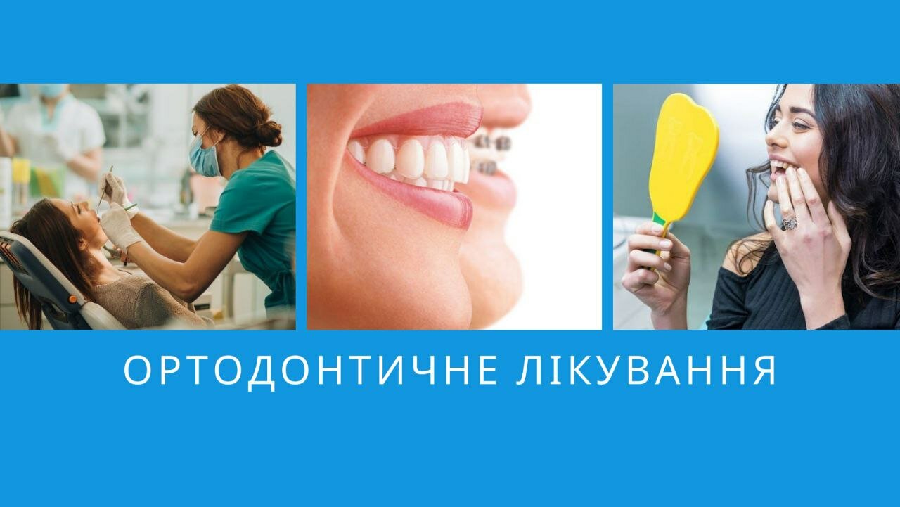 Ортодонтичне лікування